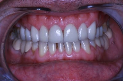 Post op facettes 002 jvmhpt - Eugenol