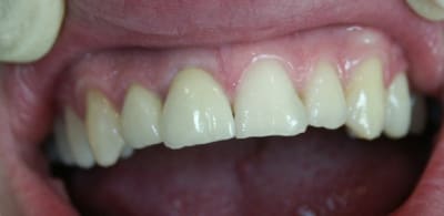 Postccm yrsftm - Eugenol