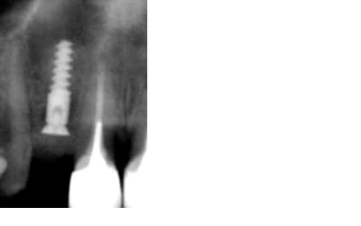 Post op 14mai a  iqvuoj - Eugenol