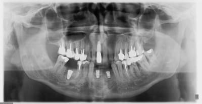 Post op adk0n6 - Eugenol
