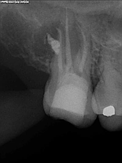 Post op curetage 2007 oexrsw - Eugenol