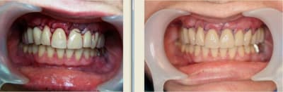 Postop 24h t5sqen - Eugenol