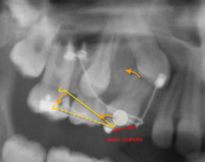 Pour utiliser le bouton coll  on1r2s - Eugenol