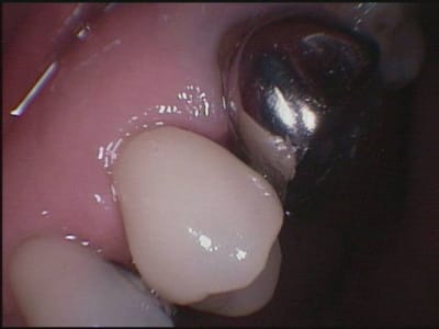 Premolaire cerec avant scellement wjkyfm - Eugenol