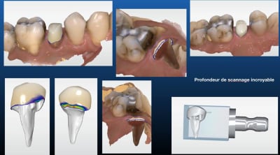 Primescan inlay core anatomique ipataw - Eugenol