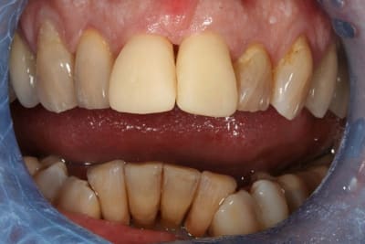 Provisoires w9xm9a - Eugenol