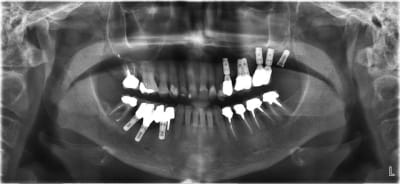 Quels implants jnnanc - Eugenol