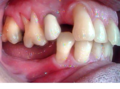 Récession cjnq5x - Eugenol