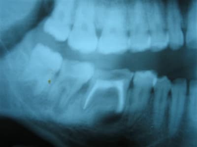 Réimplantation agyq5e - Eugenol