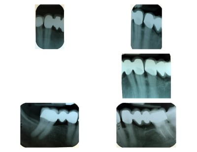 Radio zirconia q5smv5 - Eugenol