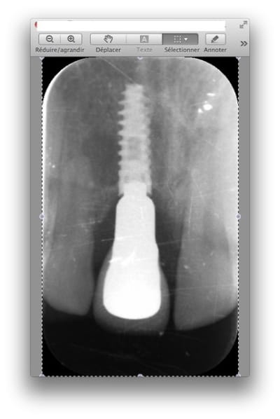 Radioimplant evzbug - Eugenol