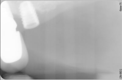 Radio implant inconnu skkong - Eugenol