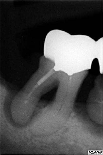 Re molaire omg nrou60 - Eugenol
