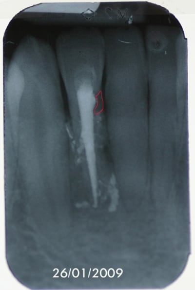 Resorption 2 copie t62bud - Eugenol