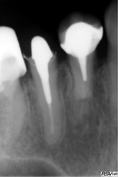 Resorption hnmwtt - Eugenol