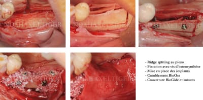 Ridge splitting mandibule jeld14 - Eugenol