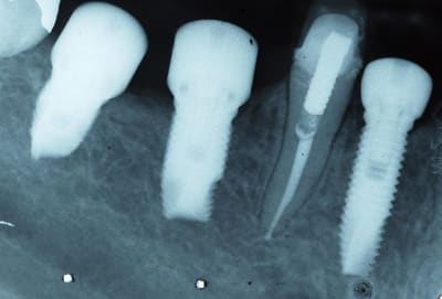 Rxc mai 2007 implants 47 et  46 et 44  ter tprevs - Eugenol
