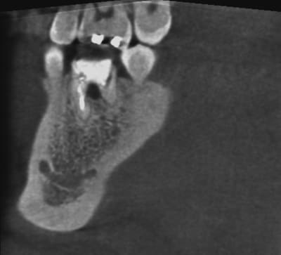 Sagittal jv40hr - Eugenol