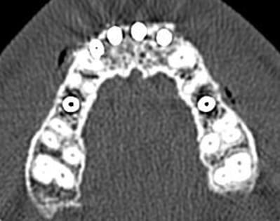 Scanner implant 12 ii tyqnzy - Eugenol