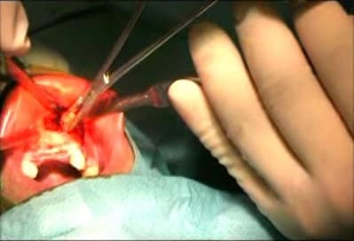 Second greffon 2 rc0x4t - Eugenol