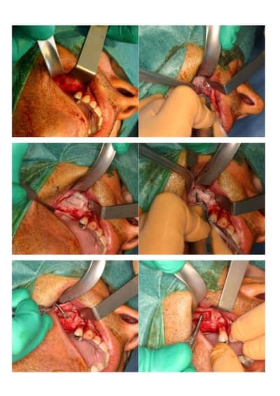 Sinuslift1 wpbdaq - Eugenol