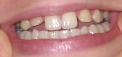 Smiile 2 vuvgte - Eugenol