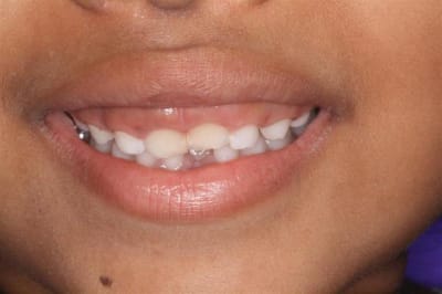 Sourire gingival   6 ans 008  medium  pvwgsq - Eugenol