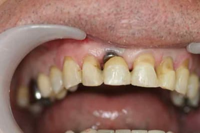 Splint  i4qpfz - Eugenol