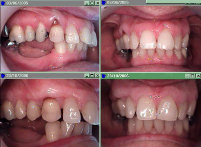 Suite greffe ynlb7g - Eugenol