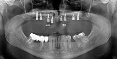Supression complet 4 ge9ics - Eugenol