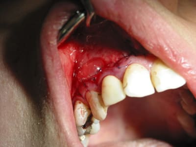 Sutures et bulles. - Eugenol
