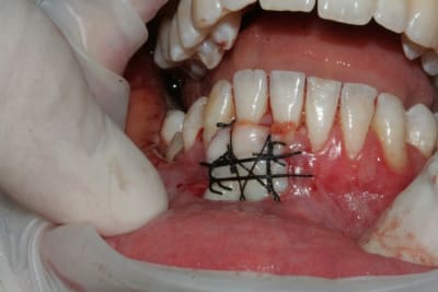 Sutures s9jjlz - Eugenol