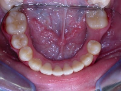 Tache rouge mai 2009 t2mdvi - Eugenol