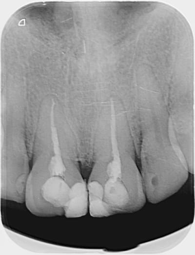 Traitement endo juillet 2013 mkdloo - Eugenol