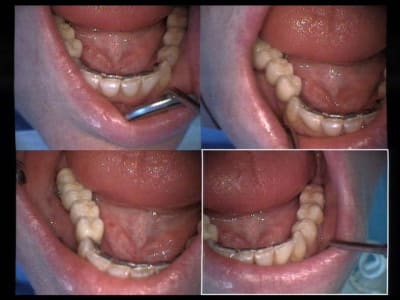 Un cas difficile implants une vue presque finale 2 e6u7kz - Eugenol