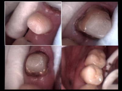 Un cas difficile vmk 35 et 36 scellement h7wup5 - Eugenol
