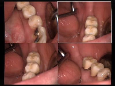 Un cas difficile vmk scellées sur 36 et 35 r1imgj - Eugenol