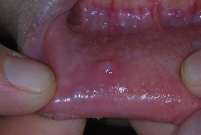 Vesicule xxthp7 - Eugenol