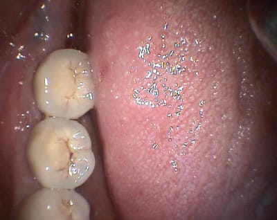 Vestibulaire sk0lsv - Eugenol