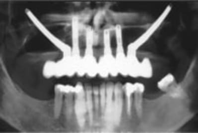 Zygoma start x ray tcm57 16556 tz6lj0 - Eugenol