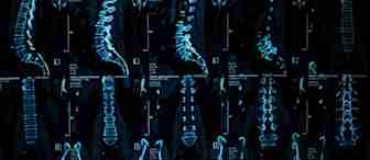 A composite image of multiple spinal X-rays showing various views and angles of the spine, including lateral and front views. The images display vertebrae, intervertebral discs, and other spine structures in shades of blue against a dark background.