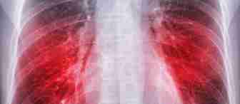 Chest X-ray showing the lungs with highlighted red areas, indicating possible infection, inflammation, or disease such as pneumonia. The spine and ribs are also visible in the image.