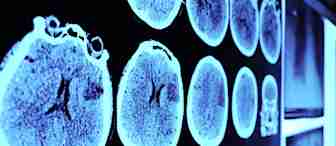A series of MRI brain scans displayed on a light board, showing various cross-sectional views of the brain in shades of blue. The images reveal detailed brain structures, with some scans focusing on different areas for examination.