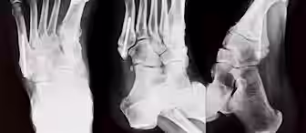 An X-ray image showing three different angles of a foot, highlighting the bones and the presence of a surgical screw fixing a fractured bone in the middle toe. The image captures the top view, side view, and oblique view of the foot.