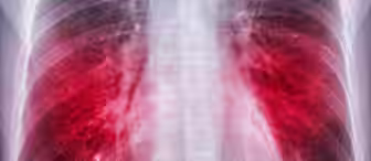 Chest X-ray showing the lungs with highlighted red areas, indicating possible infection, inflammation, or disease such as pneumonia. The spine and ribs are also visible in the image.