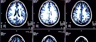 A set of six black-and-white brain MRI scans, arranged in two rows of three, showing cross-sectional images of the human brain. Each image displays different levels of brain structure detail, highlighting various regions and patterns within the brain.