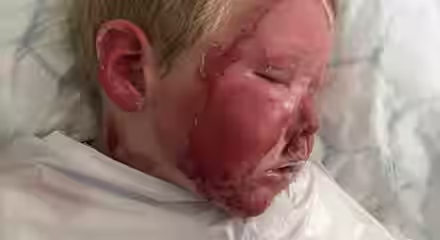 A young child with blond hair lies on a hospital bed, their face covered in severe red burns on the left side. The child is wearing a white medical gown and appears unconscious, with eyes closed and facial expression neutral.