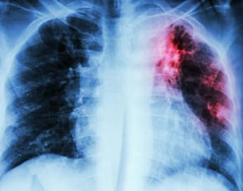 An X-ray image of a human chest showing the ribcage and lungs. The right lung appears darker and has a large red area, indicating a possible abnormality or condition, while the left lung appears normal.