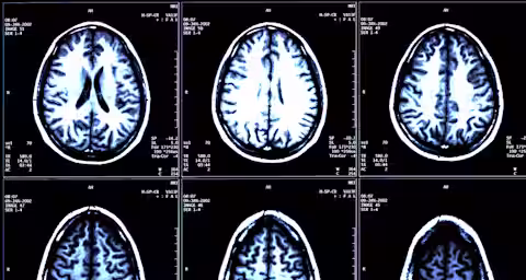 A set of six black-and-white brain MRI scans, arranged in two rows of three, showing cross-sectional images of the human brain. Each image displays different levels of brain structure detail, highlighting various regions and patterns within the brain.