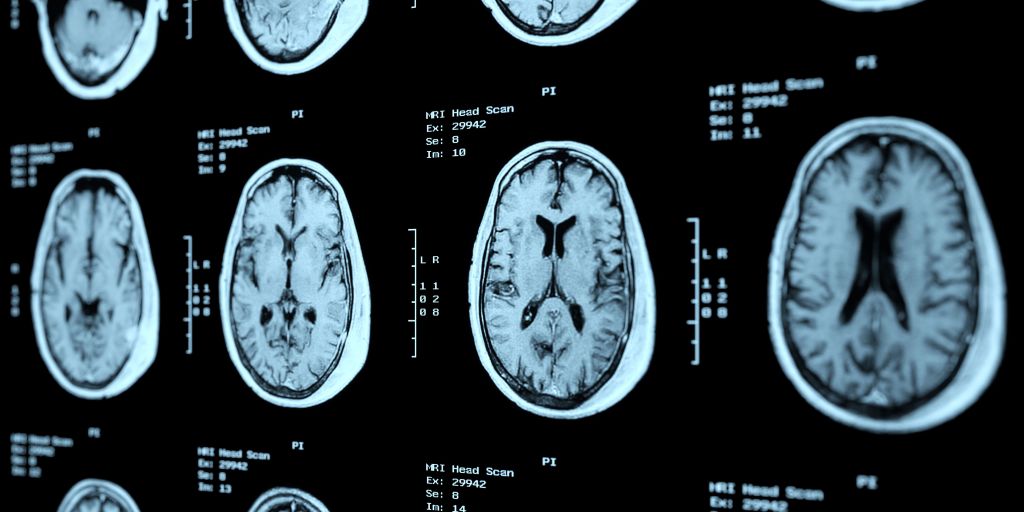 do-concussions-cause-cte-sharecare